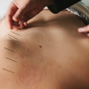 massage and acupuncture can help you become pain free