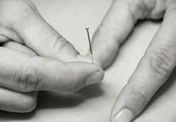 try acupuncture