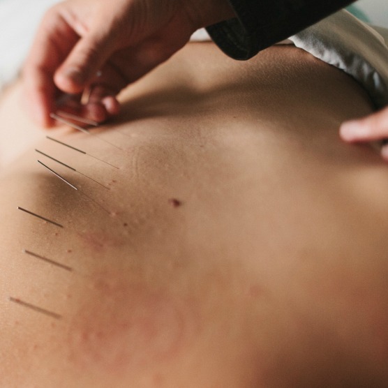 acupuncture